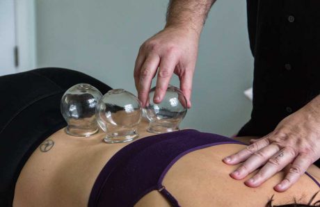 cupping